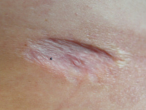 Atrophic surgical scar