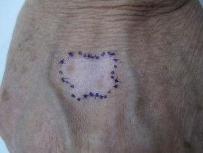 Punch grafting in vitiligo