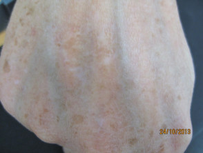 Punch grafting in vitiligo