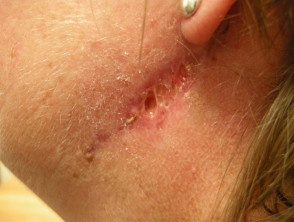 Surgical wound dehiscence