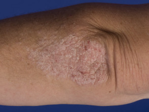 Chronic plaque psoriasis of elbow