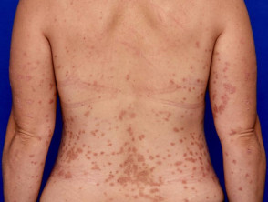 Psoriasis moderate on back