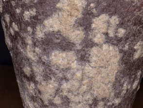 Psoriasis with very thick scale