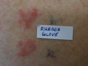 Allergic contact dermatitis to rubber