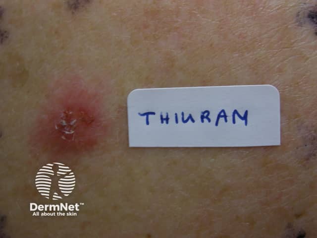 Reaction to thiuram, a component of rubber gloves
