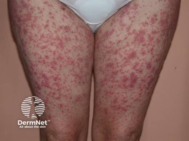 An exanthematous sulfonamide reaction