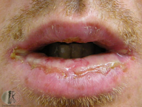 Erythema multiforme of lips