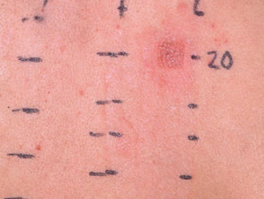 Positive patch test to PPD
