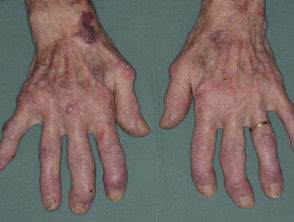 Rheumatoid arthritis of hands