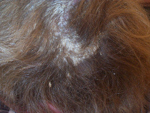 Psoriasis of the scalp