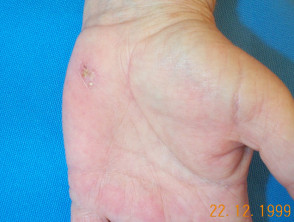 Pustular psoriasis of the hands and fee