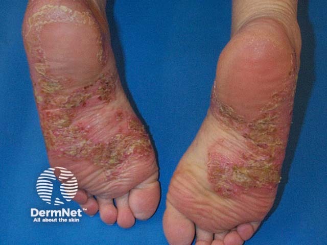 Typical lesions of PPP on the soles - redness, scale, pustules, and rusty red dots