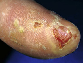 Acrodermatitis continua of Hallopeau
