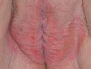 Vulval psoriasis
