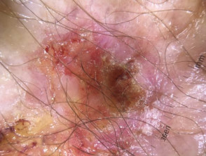 Squamous cell carcinoma in situ
