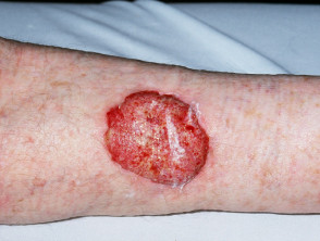 High-risk squamous cell carcinoma