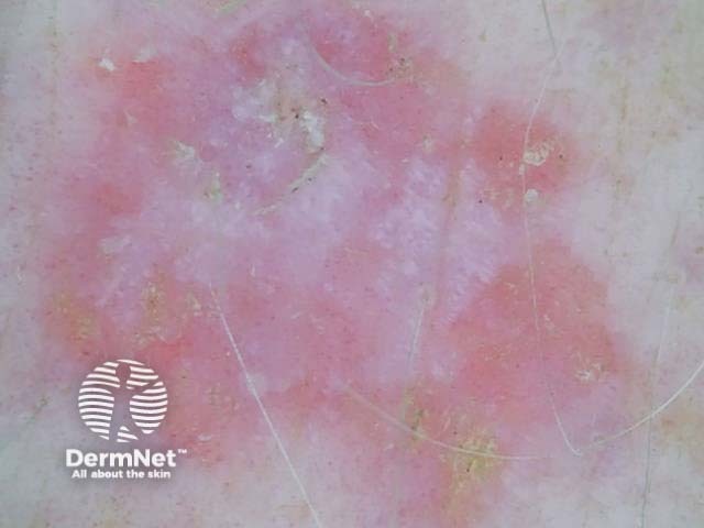 Intraepidermal carcinoma dermoscopy