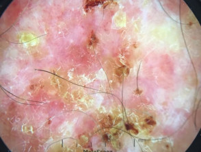 Squamous cell carcinoma in situ