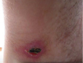 Scrub typhus initial lesion