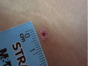 Scrub typhus healing lesion