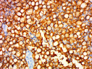 `Signet ring lymphoma pathology stained with  CD20 x400