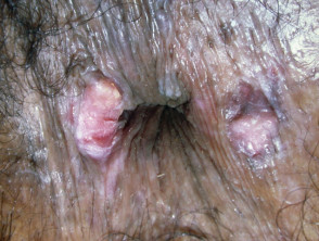 Peri-anal squamous cell carcinoma in situ