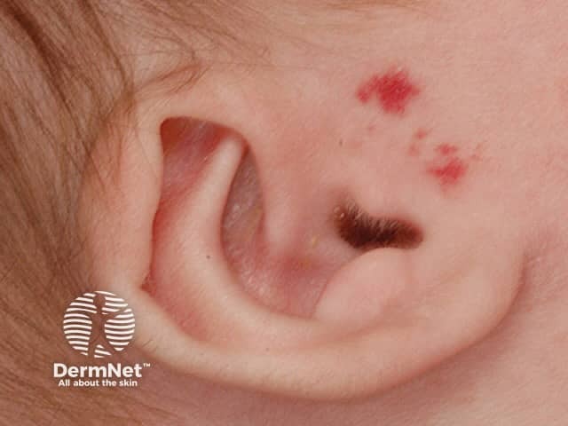 Preauricular infantile haemangioma