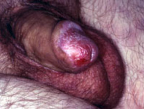 Penile intraepithelial neoplasia