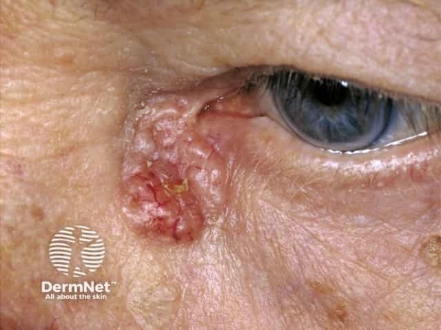 Basal cell carcinoma