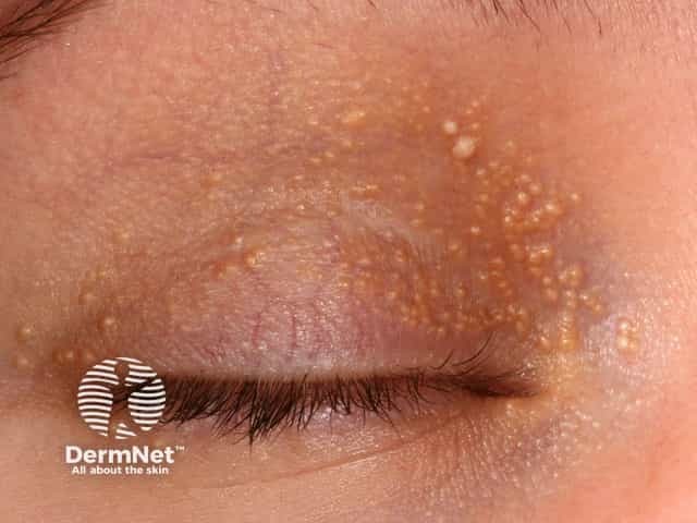 Eyelid milia