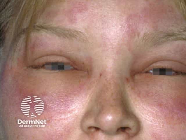 Acute angioedema of the face and lids during an attack of anaphylaxis