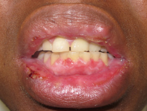 Oral erythema multiforme