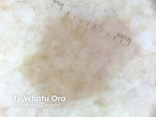 Dermoscopy of a solar lentigo