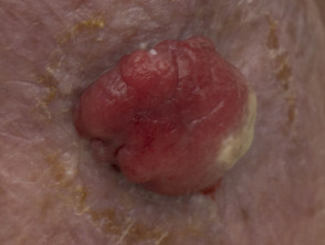 Spindle cell melanoma