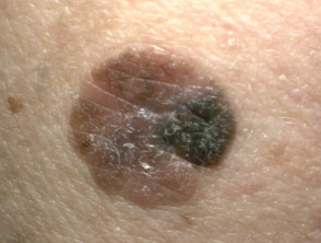Spindle cell melanoma