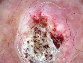 Squamous cell carcinoma polarised dermoscopy view