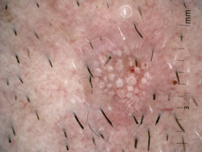 Squamous cell carcinoma nonpolarised dermoscopy view