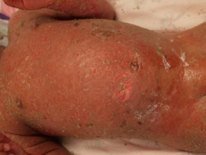 Staphylococcal scalded skin syndrome