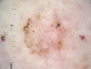 Superficial basal cell carcinoma polarised dermoscopy view