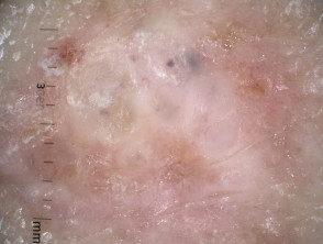 Superficial basal cell carcinoma nonpolarised dermoscopy view