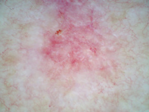 Superficial basal cell carcinoma polarised dermoscopy view