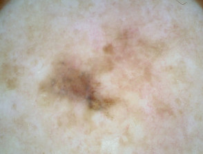 Superficial spreading melanoma, Breslow 0.7mm, arising within a melanoma in situ, nonpolarised dermoscopy view