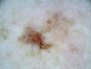 Superficial spreading melanoma, Breslow 0.7mm, arising within a melanoma in situ, polarised dermoscopy view