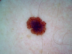 Superficial spreading melanoma, Breslow 0.4 mm, nonpolarised dermoscopy view