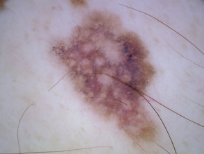 Superficial spreading melanoma, Breslow 0.4 mm, nonpolarised dermoscopy view