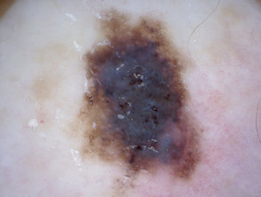 Superficial spreading melanoma, Breslow 0.5 mm, nonpolarised dermoscopy view