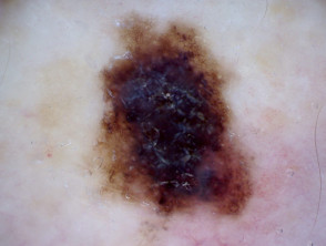 Superficial spreading melanoma, Breslow 0.4 mm, polarised dermoscopy view