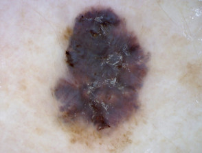 Superficial spreading melanoma, Breslow 1.0 mm, nonpolarised dermoscopy view