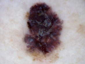 Superficial spreading melanoma, Breslow 0.25 mm, polarised dermoscopy view