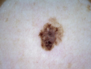 Superficial spreading melanoma, Breslow 0.5 mm, nonpolarised dermoscopy view